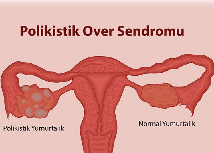 Polikistik Over Sendromu (PCOS) ve Beslenme: Bilimsel Yaklaşım ve Örnek Menü